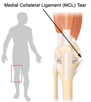 Medial Collateral Ligament Tear