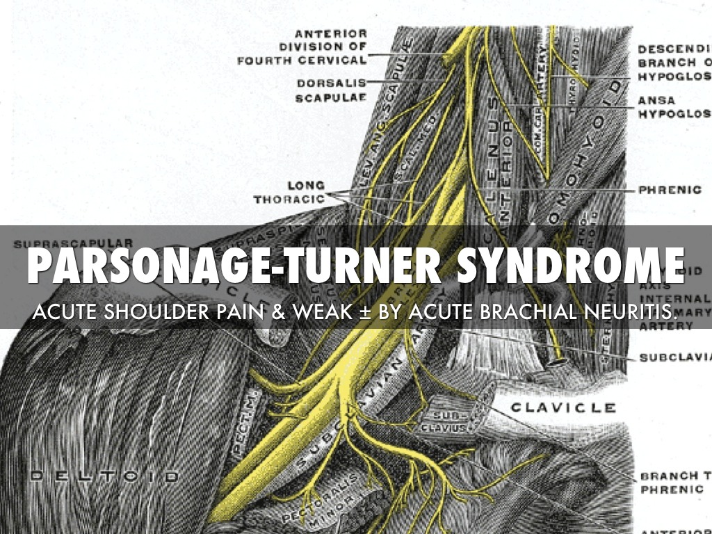 Parsonage Turner Syndrome