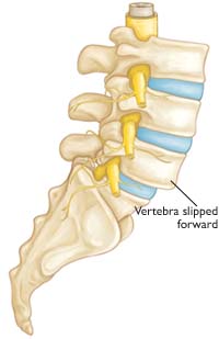 Spondylolisthesis