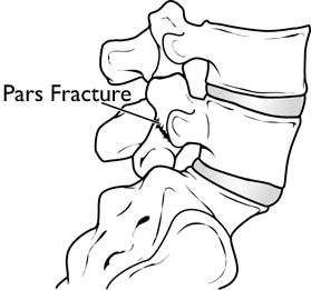 Pars Fracture