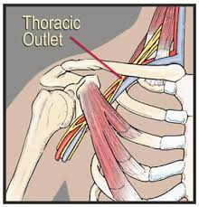 Thoracic Outlet Syndrome