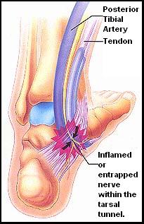 Posterior Tarsal Tunnel Syndrome