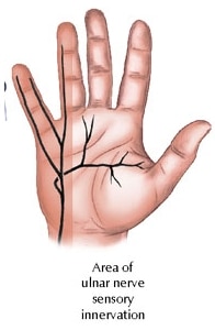 Ulnar Tunnel Syndrome